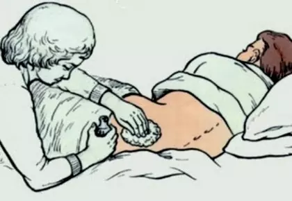 Уход за больным после инсульта. Профилактика пролежней